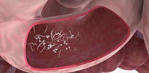 L'utilisation de milliers de milliards pour éliminer les parasites