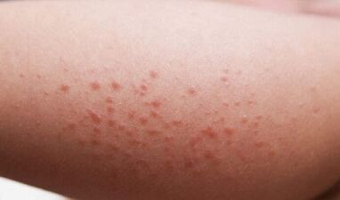 Manifestations externes de la présence de parasites dans l'organisme.